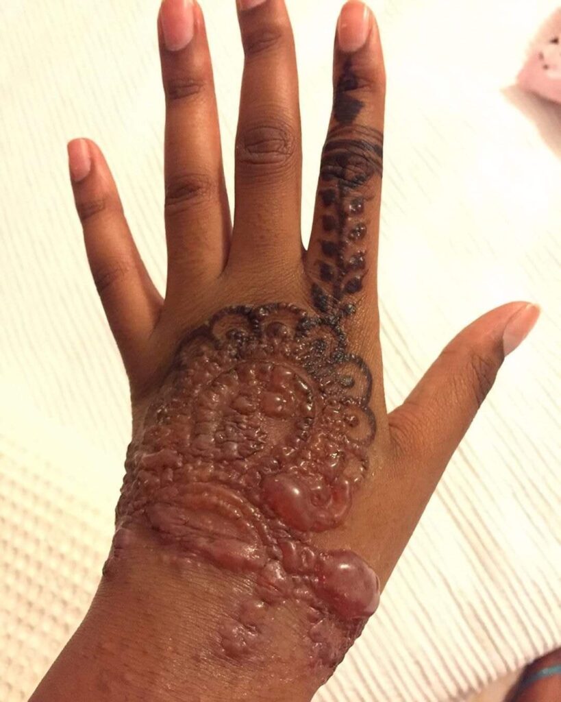 Lady in pain and tears after applying Henna Tattoos to her hand (photos)