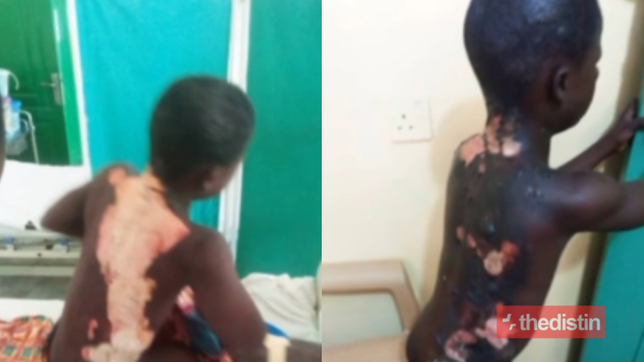 10-year-old Kasoa Boy Who Was Set On Fire By 14-year-old Boy Reveals What He Told Him